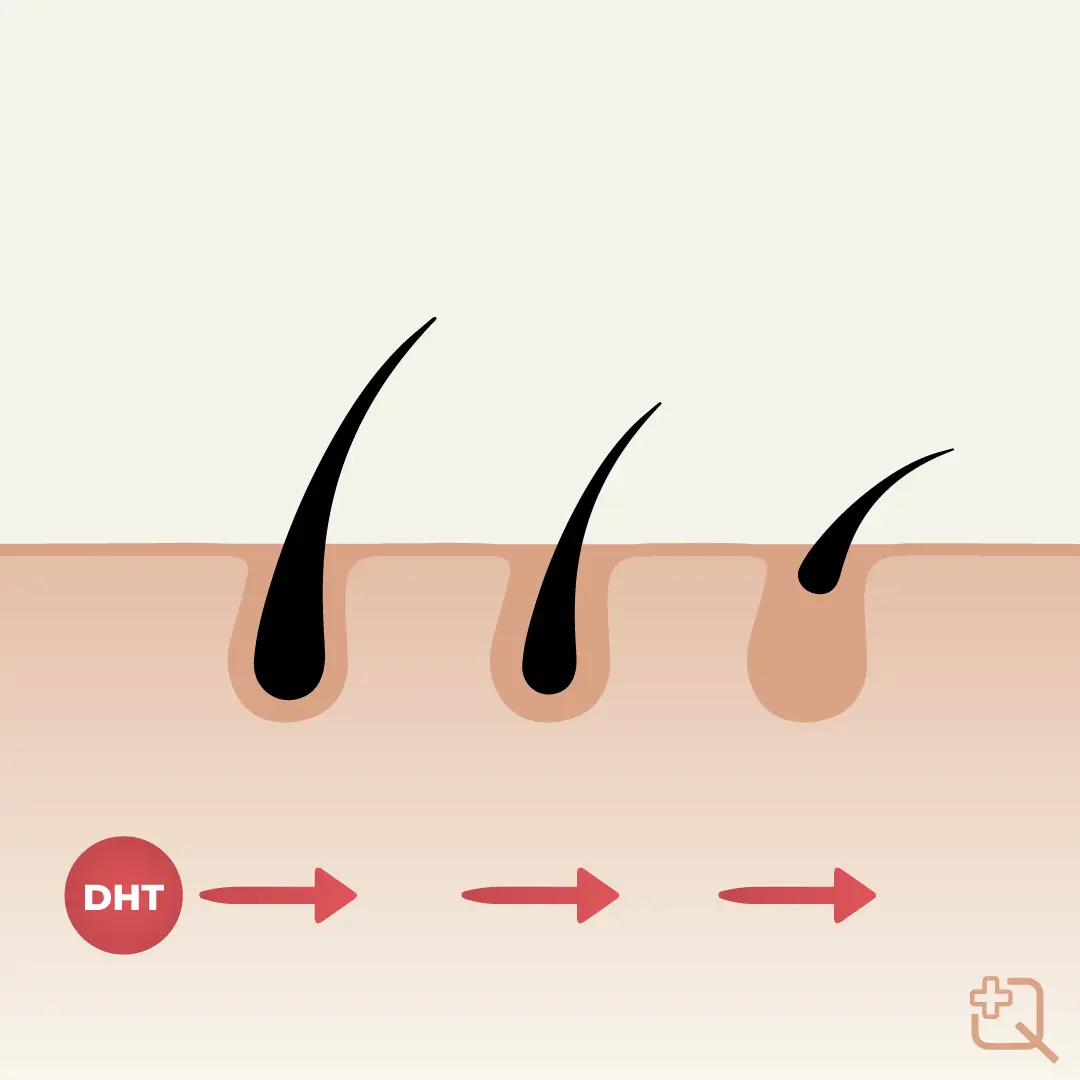 Why do we lose hair?